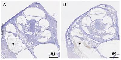 Insertion trauma of a novel inner ear catheter for intracochlear drug delivery